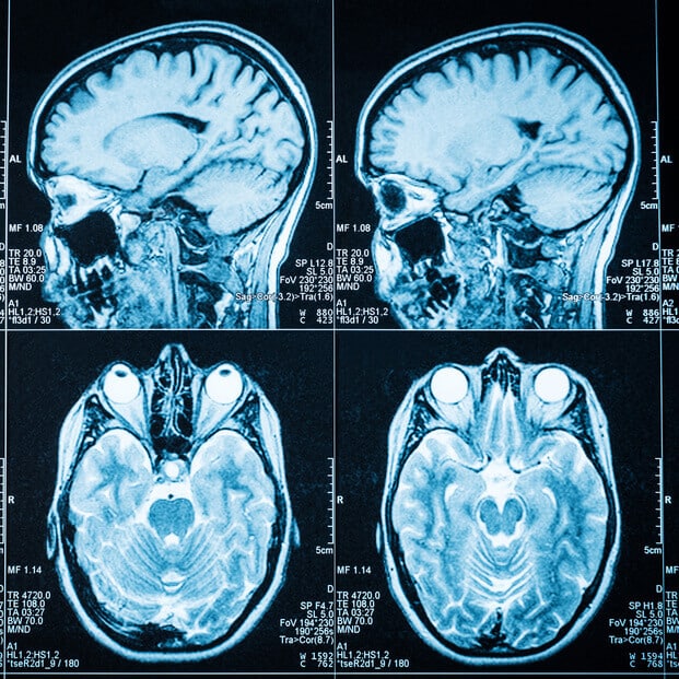 Staring death in the face, survival, and moving on - IRIS FMP UK